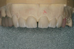 Figure  15  OE1 was then placed in the mesial and distal troughs, as well as in between the mamelons.
