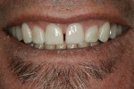 Figure  19  A 1:2 natural smile photograph of the final restorations.