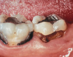 Figure  1  CLINICAL CASE Preoperative root surface caries.