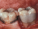 Figure  3  CLINICAL CASE Final restorative therapy of root surface caries.