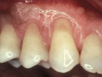 Figure  4  FLAP PROCEDURE  Exposed root surface without caries.