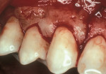 Figure  5  FLAP PROCEDURE  Coronally positioned flap to cover exposed root surface.