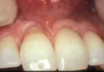 Figure  8 TISSUE GRAFT  Exposed root surface without caries.