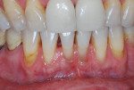 Fig 1. Mucogingival defect on tooth No. 24 at initial examination.