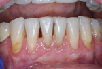 Fig 5. Eight weeks after the No. 24 free gingival
graft.