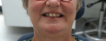 Fig 7. A close-up of the patient’s face in a smile position.