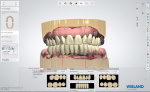Fig 10. Digital software is used to design the restorations, incorporating a photo of the patient to match the design to her natural dentition.