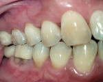 Fig 11. Buccal view at 9-month follow-up.