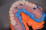 Fig 5. The patient’s prior denture is used for bite and impression.
