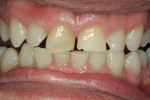 Figure 7  Teeth after 5 weeks of nighttime vital bleaching with 10% carbamide peroxide to minimize the amount of color the composite would need to mask.