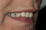 Figure 17  Right lateral smile with improved facial contours and arch form.