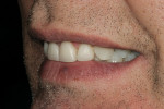 Figure 18  Left lateral smile view.