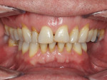 Preoperative retracted smile photograph.