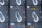 Fig 1. CBCT with mini-implant overlay (1:1) (Fig 1); two MDIs in the No. 19 and 20 positions (Fig 2); panoramic radiograph showing cemented two-unit splinted PFM MISFR for Nos. 19 and 20 3.5 years after cementation of final restoration (Fig 3).