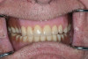 Figure 9  Vertical components of crown height space for a bar-retained implant overdenture.