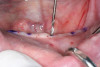 Figure 10c  Traditional fixed prosthodontics performed to level the opposing arch and regain sufficient crown height space.