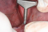 Figure 11b  Osteoplasty performed at the time of implant placement to gain sufficient crown height space.