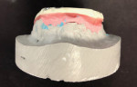 Fig 2. The TriLor frame is blocked out with wax to scan for Pala Digital Denture.