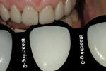 Figure 2  Shading tool to determine Bleaching 2 color for centrals.