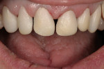 Figure 7  Try-in after dentin layering.