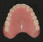 Figure 1  Maxillary complete denture with anatomical teeth (Vitapan<sup>®</sup> Cuspiform 23º to 28º).