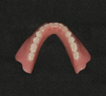 Figure 2  Mandibular stress-broken, two-implant bar overdenture with abraded teeth (Vitapan<sup>®</sup> Synoform 0º to 5º).