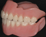 Figure 3  Maxillary complete denture and mandibular implant stress-broken overdenture.