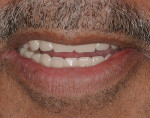 Figure 4  Vitapan<sup>®</sup> anterior and posterior teeth.
