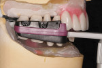 Figure 7  Filou 28 Denture set-up system: maxillary and mandibular teeth-jig assembly. Teeth are ready to seal in wax to underlying denture transitional acrylic bases.