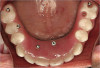 Figure 5  DIAGNOSTIC INFORMATION After orthodontic therapy, the radiograph did not provide enough diagnostic information to determine if implants could be placed.