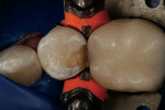 Figure 3  Occlusal view of the sectional matrix.