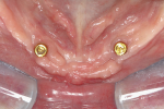 Fig 2. Occlusal view of mandible showing ideal implant placement. (Surgery by Georgios Romanos, DDS, PhD.)
