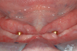 Fig 3. Frontal view of mandible showing ideal LOCATOR abutment height. (Surgery by Georgios Romanos, DDS, PhD.)