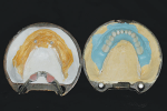 Fig 17. Flasked mandibular tooth arrangement and framework after wax elimination.