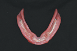 Fig 19. Intaglio of mandibular overdenture after placing COE-SOFT in the position of the future LOCATOR attachments.