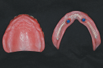 Fig 20. Intaglio of maxillary complete denture and mandibular overdenture, 2 weeks after delivery with LOCATOR housings and attachments in place.