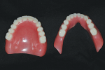 Fig 21. Cameo of maxillary complete denture and mandibular overdenture, 2 weeks after delivery.