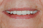 Fig 27. Patient smiling with final prostheses.