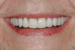Fig 28. High smile line with final prostheses.