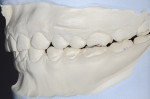 Fig 6. Therapeutic jaw joint position.