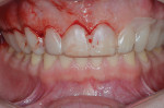 Fig 9. Gingivotomy, first cut with guides in place.