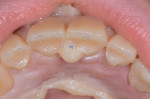 Fig 12. Platform between teeth Nos. 8 and 9, in maximum intercuspation on all back teeth.