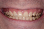 Fig 11. Patient’s smile, 3 months after osteo-gingivoplasty procedure.