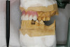 Figure 25  VIRTUAL PLANNING AND SURGERY By using segmentation techniques to remove the existing teeth, leaving the sockets, the alveolar complex was appreciated fully.