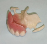 Figure 9: Completed maxillary partial with Thermoflex acetal frame and clasps.