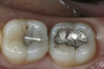 Figure 1  The patient presented with decay under the failing occlusal amalgam restorations on teeth Nos. 30 and 31.