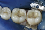 Figure 6  A nano-optimized, universal hybrid composite material (Tetric EvoCeram) in dentin shade A3 was then placed in the preparations and used to restore each cusp. The composite material was left 1 mm short of the cavosurface to leave room for th