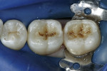 Figure 7  An ochre (Tetric Color) stain was added to the restorations using a #10 endodontic file to create groove stains. Dark Brown stain (Tetric Color) was also added to further characterize the grooves created in the restorations.