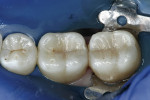 Figure 10  Before finishing and polishing, Bleach Incisal shade (Tetric EvoCeram) was painted around the margins and cured.