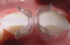 Figure 43  FINAL RESULTS The final radiograph confirmed the fit of the abutment-implant-crown interfaces.